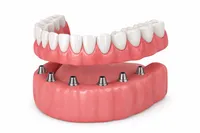 Implante com prótese protocolo